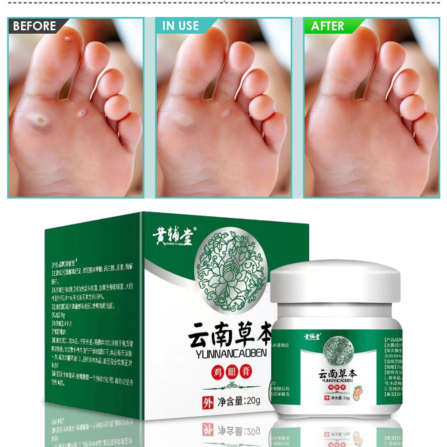 Banzch Corn Plaster Super Strong Made From Natural Plant Extracts For Foot And Body 20g,Mothers Day Gifts