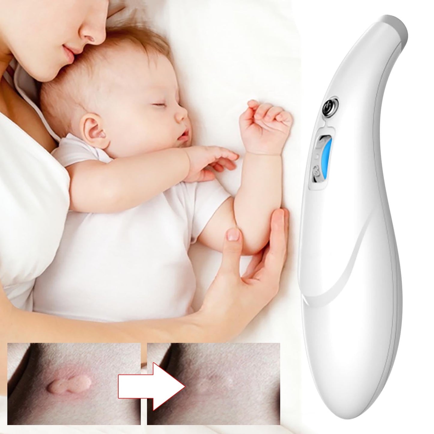 Banzch Insect Bites Healer Without Chemicals, For Treating Insect Bites And Bites, Electronic Heat Pen Against Itching,Mothers Day Gifts