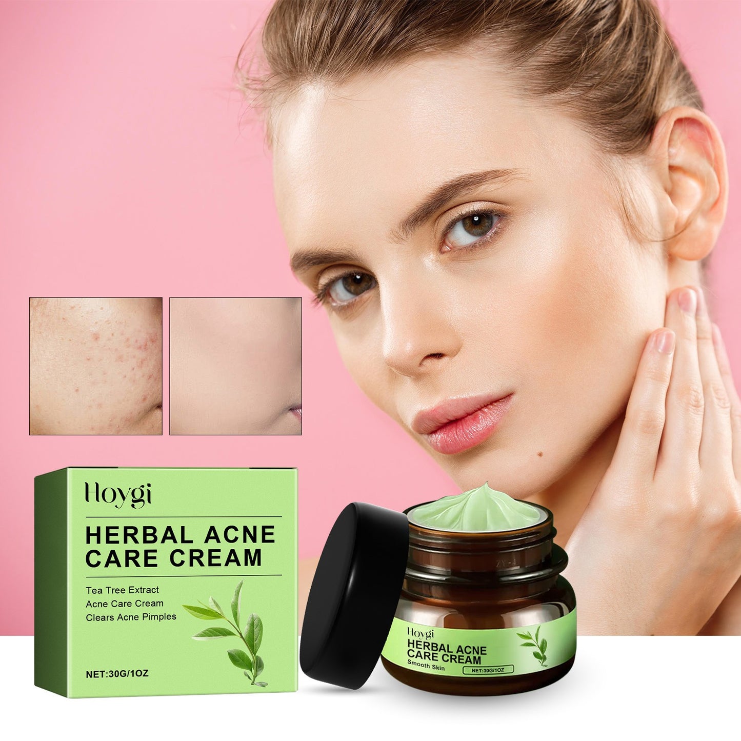 Banzch Herbal Antis-acnes Cream Fades Acnes Skin Closes Acnes Cleans Moisturizes And Smoothes The Face,Mothers Day Gifts